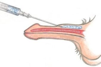 Nebezpečná metoda zvětšení penisu pomocí injekcí vazelíny